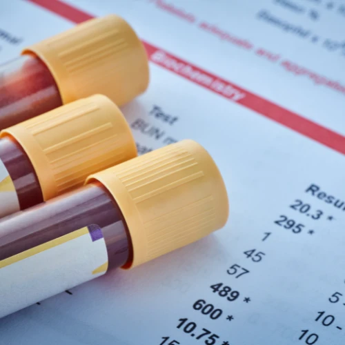 Imagen de: A.C. ÚRICO, CREATININA, GLUCOSA, UREA