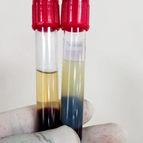 Imagen de: TRIGLICÉRIDOS